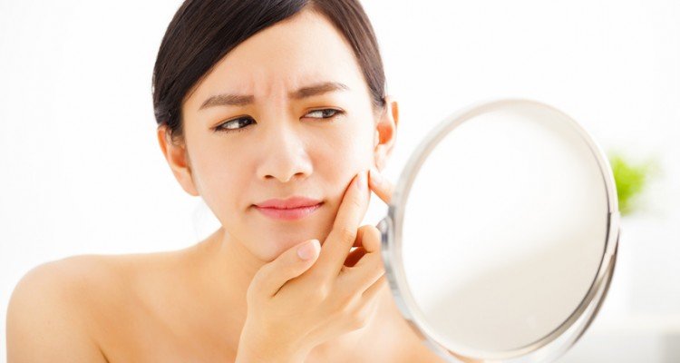 How To Prevent And Get Rid Of Acne Scars Quickly
