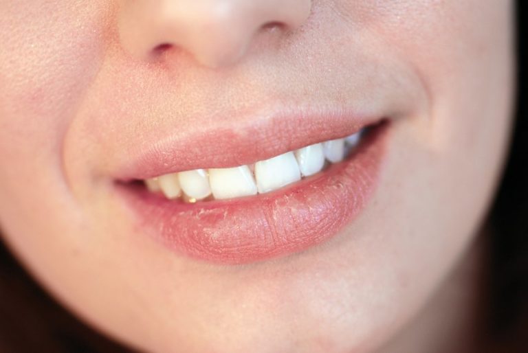 11 Proven Ways To Prevent And Get Rid Of Cold Sores Overnight